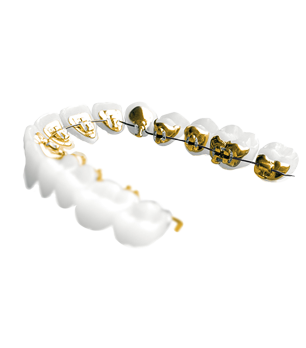 Lingual braces placed behind the teeth for teens