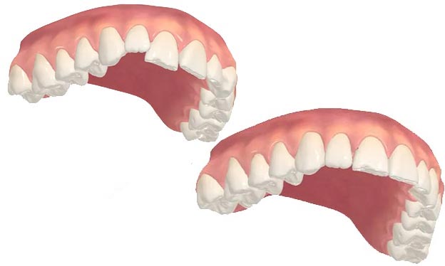 Interactive orthodontic treatment viewer displaying projected tooth movement