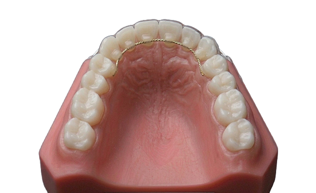 Diagram showing a bonded wire glued to the front teeth on a dental model