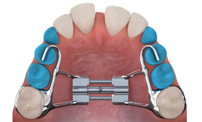 Maxillary expander orthodontic appliance diagram