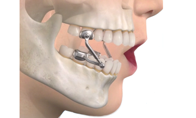 Herbst appliance orthodontic jaw correction device diagram
