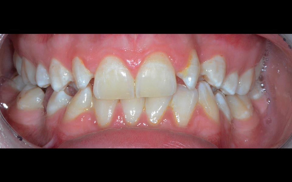 Spacing between teeth before orthodontic treatment