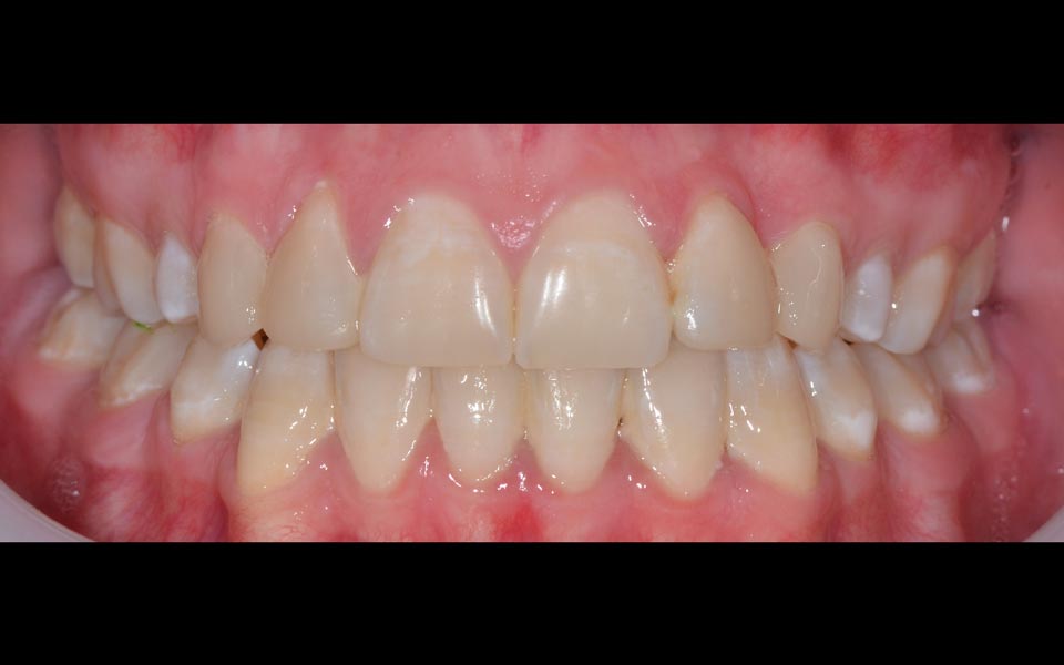 Spacing between teeth after orthodontic treatment