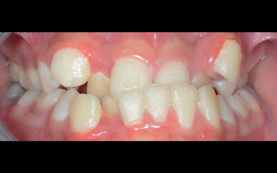 Crossbite before orthodontic correction