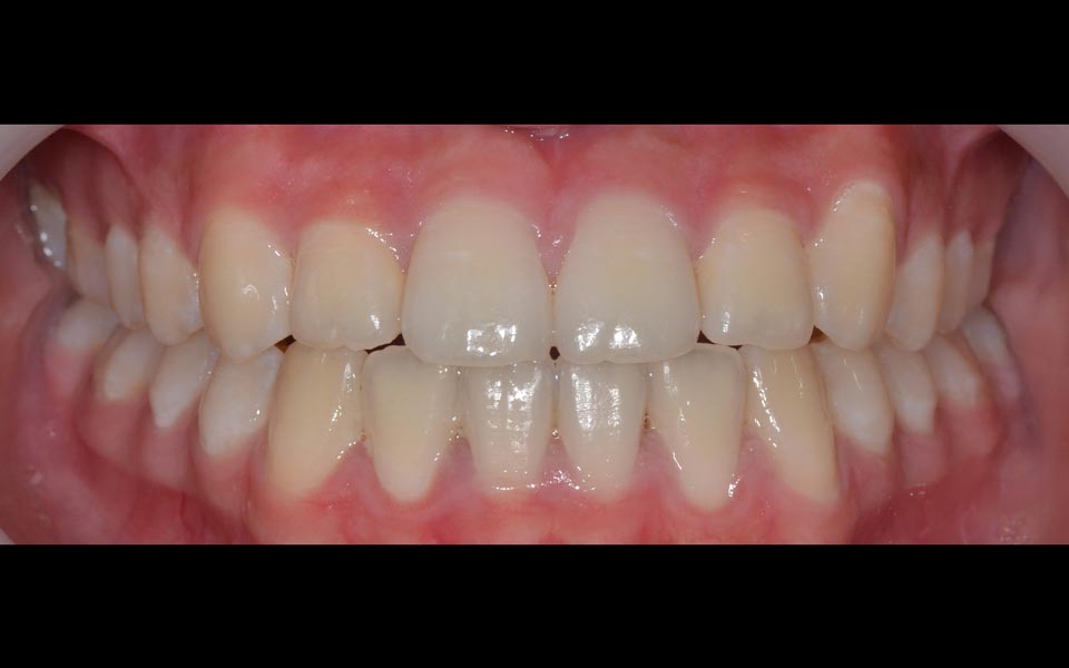 Crossbite after orthodontic correction