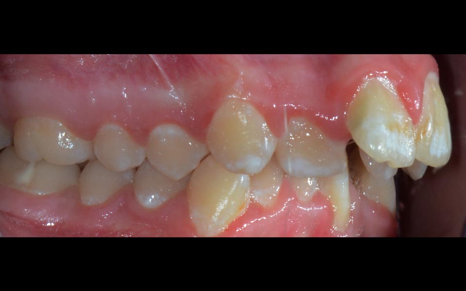 Increased overjet before treatment (adult)