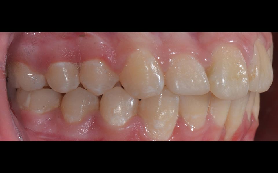 Increased overjet after treatment (adult)