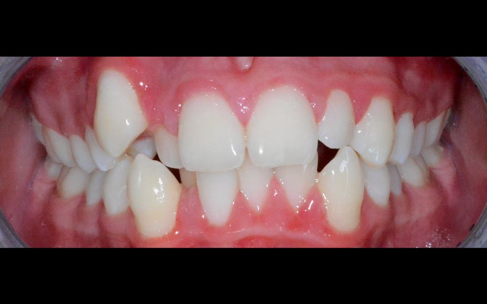 Crowded teeth before alignment