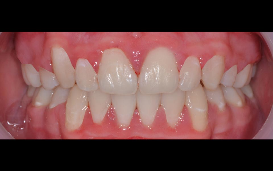 Crowded teeth after alignmentt