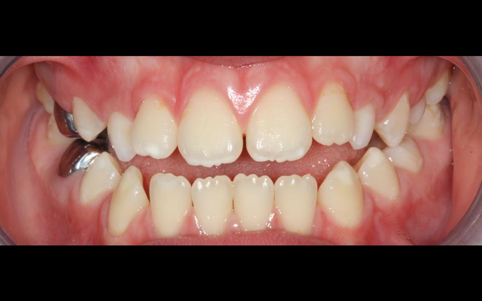 Open bite before orthodontic treatment
