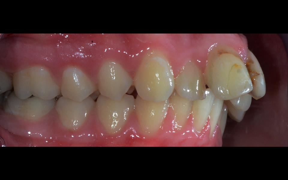 Increased overjet before treatment (child)