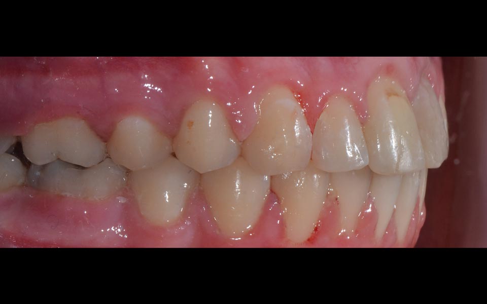 Increased overjet after treatment (child)