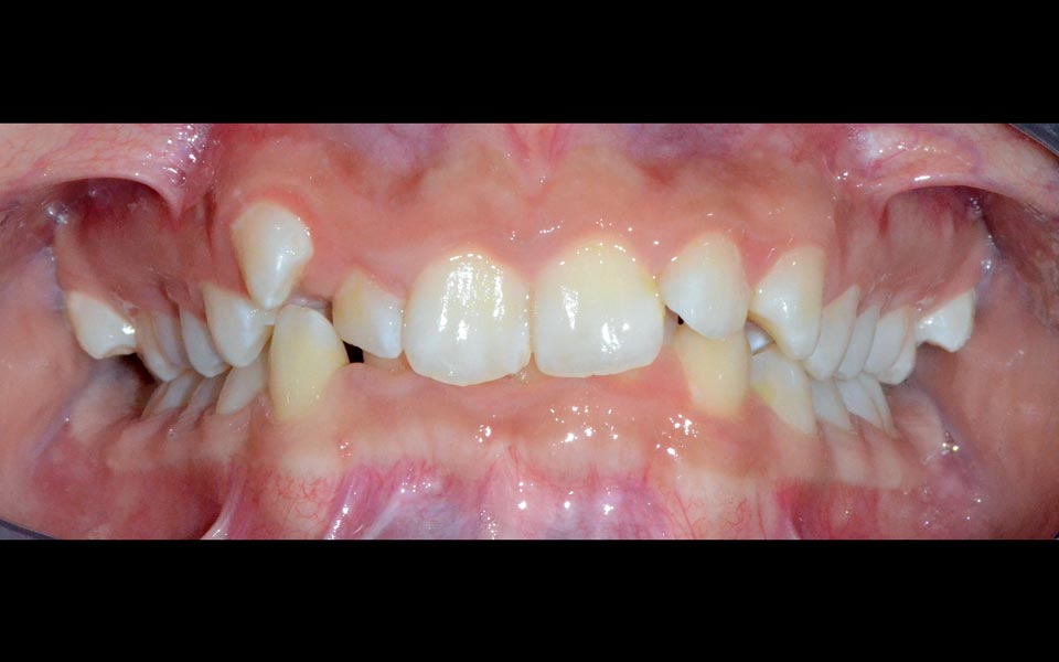 Deep bite before treatment