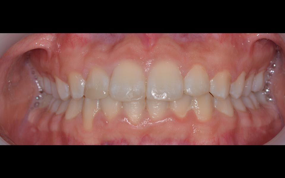 Deep bite after treatment
