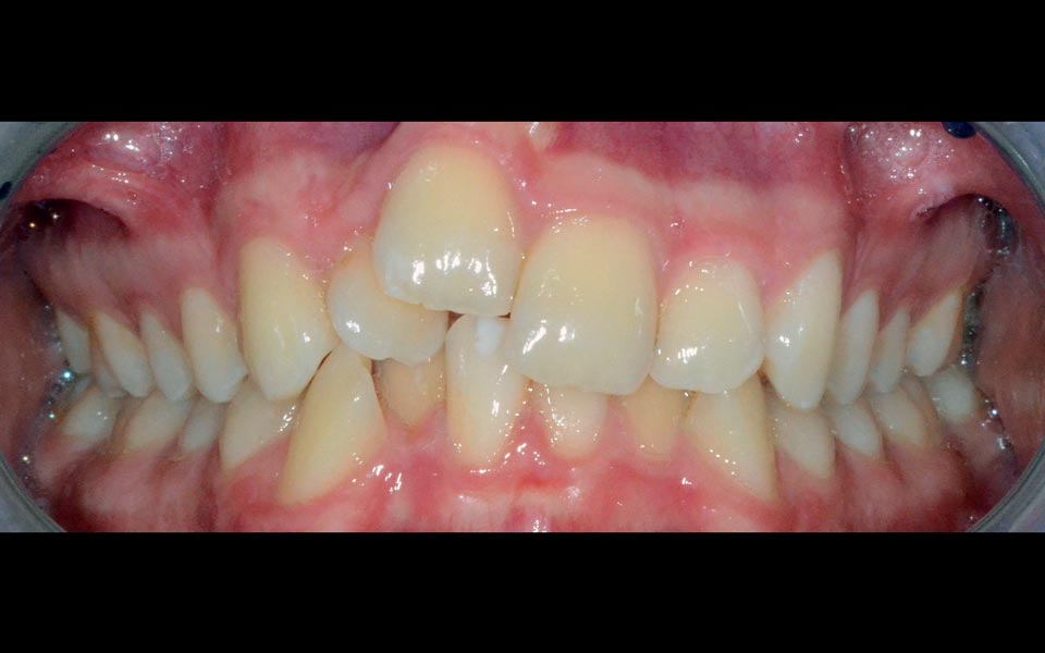Dental trauma before orthodontic management