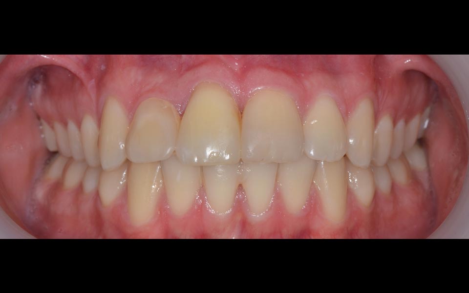 Dental trauma after orthodontic management