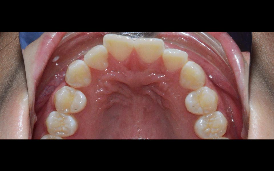 Orthodontic relapse before retreatment