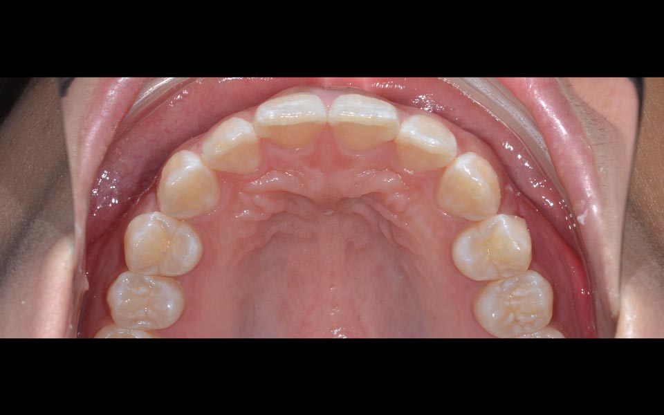 Orthodontic relapse after retreatment